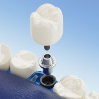 خدمات-ایمپلنت