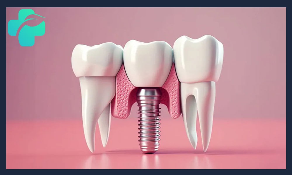 اقدامات و انواع جراحی قبل از ایمپلنت