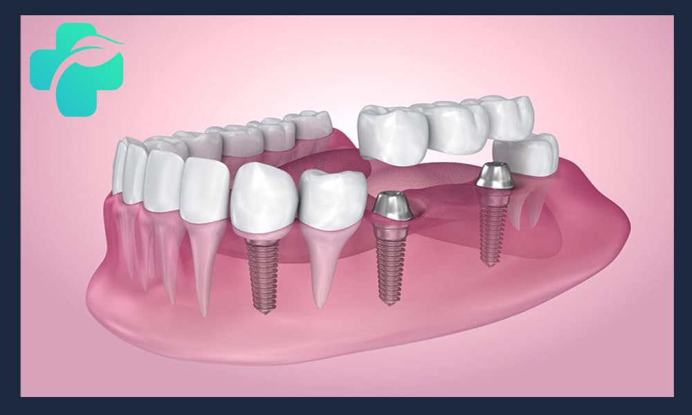 اقدامات و انواع جراحی قبل از ایمپلنت