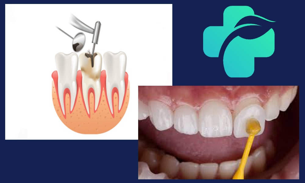 لمینت دندان عصب کشی شده