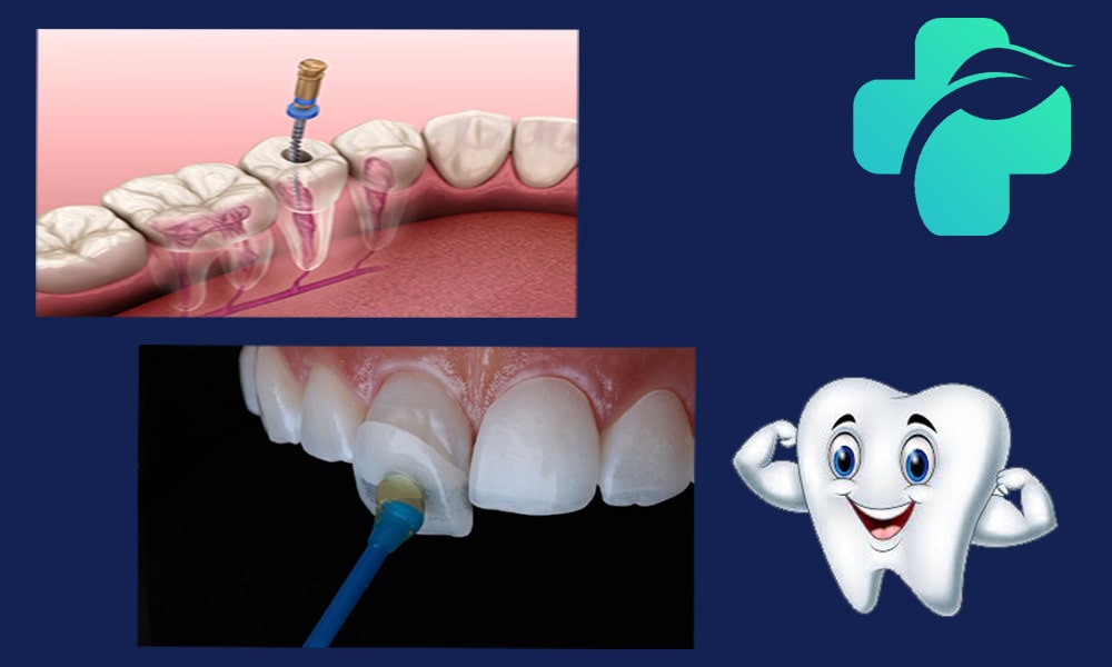 لمینت دندان عصب کشی شده
