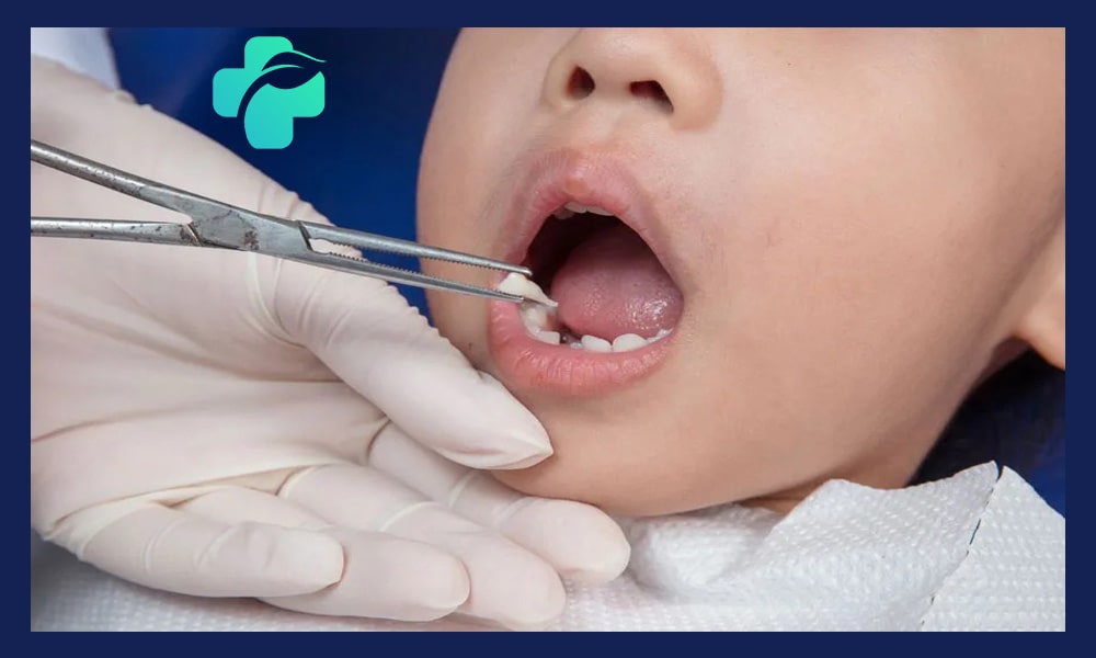 آیا کشیدن دندان شیری ضروری است؟