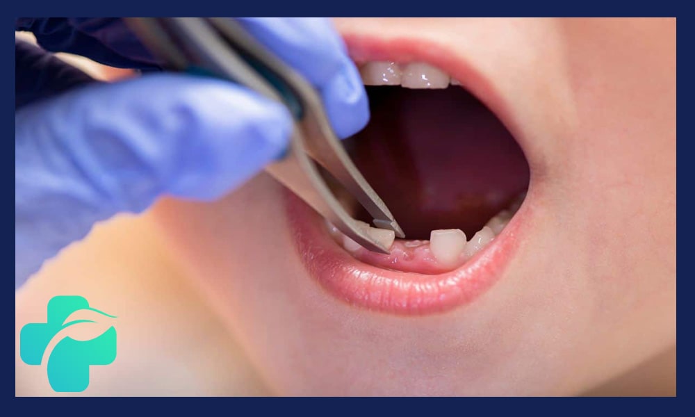 آیا کشیدن دندان شیری ضروری است؟