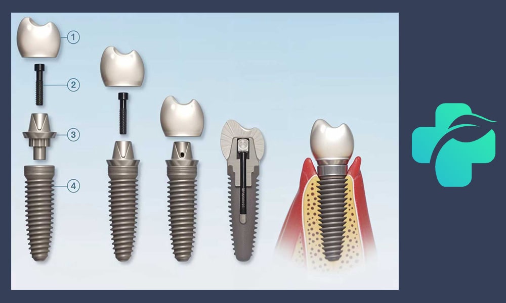 اجزای ایمپلنت دندان
