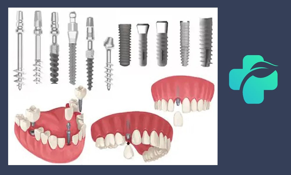 اجزای ایمپلنت دندان