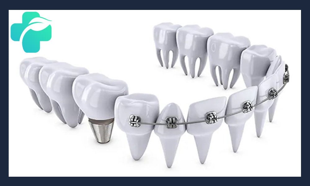 ارتودنسی دندان ایمپلنت شده