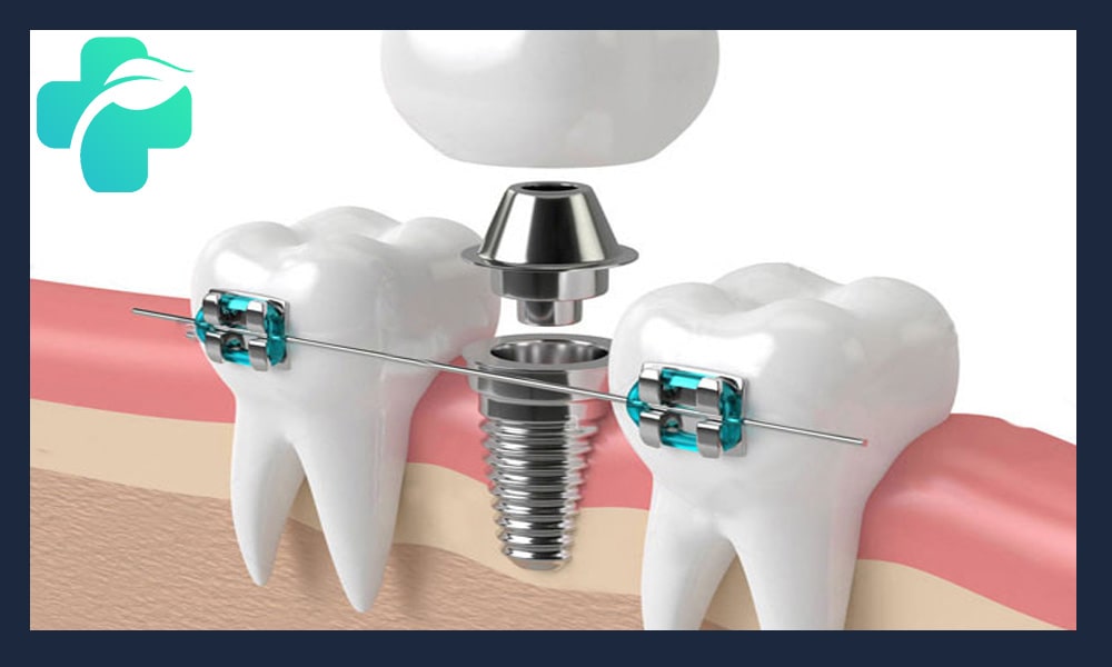 ارتودنسی دندان ایمپلنت شده