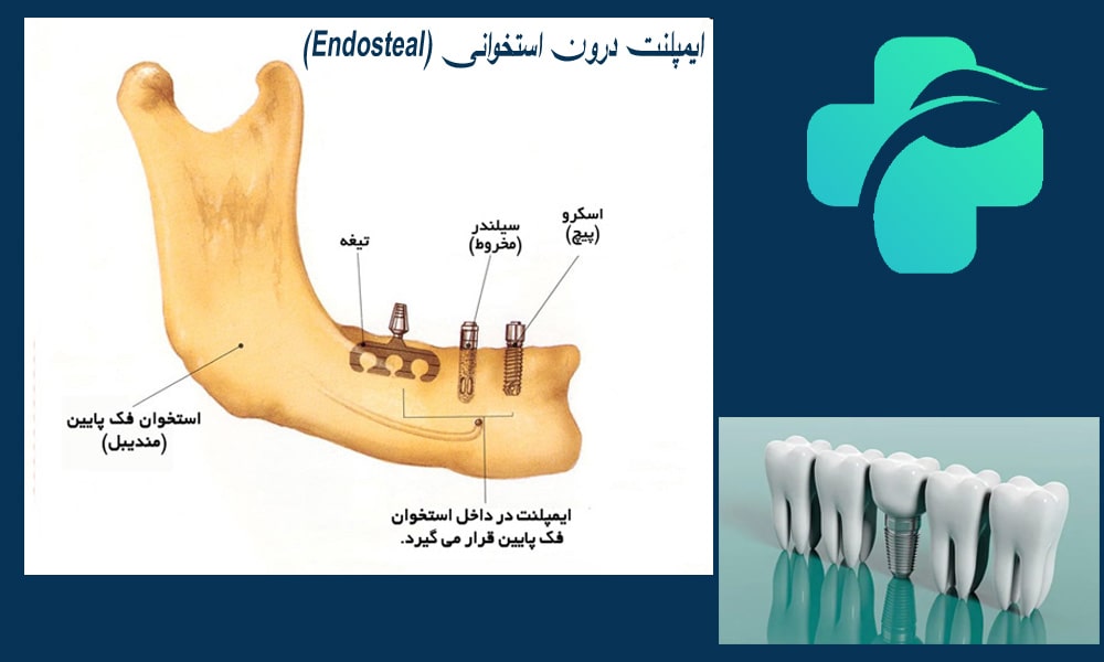 ایمپلنت های درون استخوانی (Endosteal)