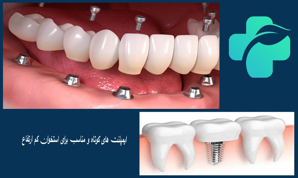 ایمپلنت های کوتاه و مناسب برای استخوان کم ارتفاع