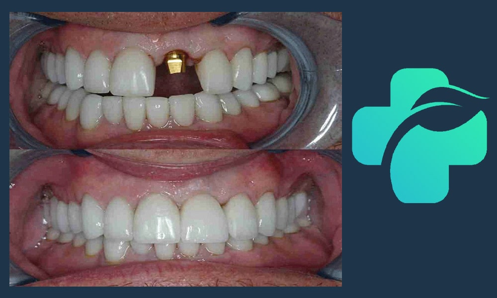 ایمپلنت دندان جلو