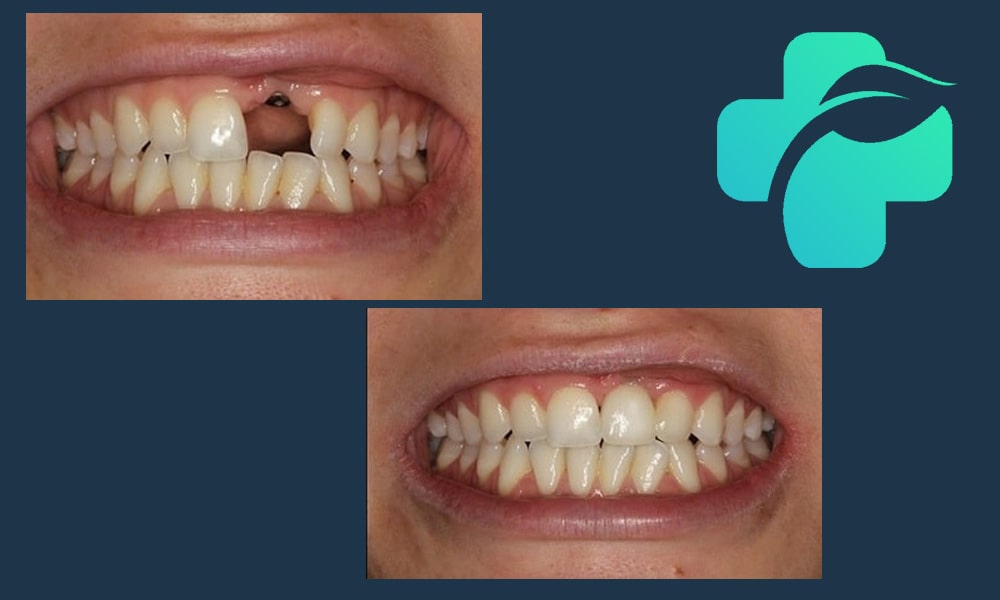 ایمپلنت دندان جلو