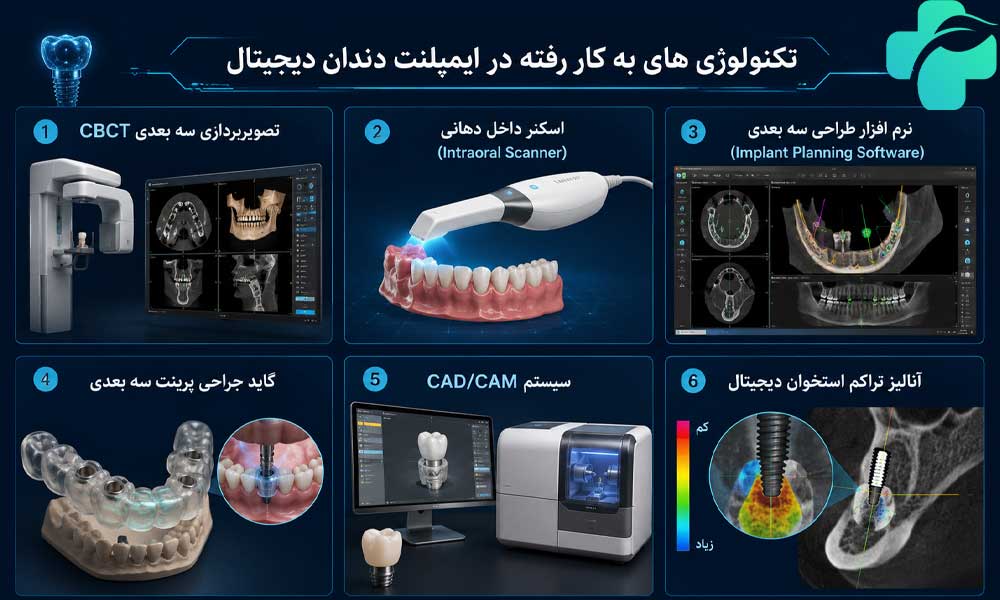 ایمپلنت دندان دیجیتال