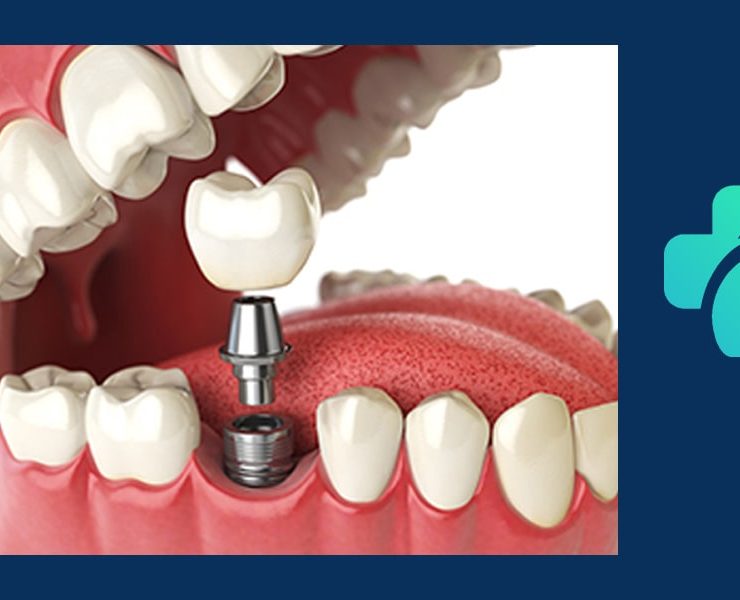 ایمپلنت فوری یا یک روزه چیست