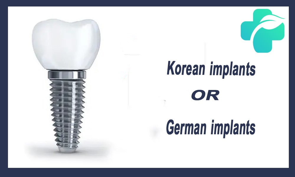 ایمپلنت کره ای یا آلمانی؟ کدام بهتر است؟
