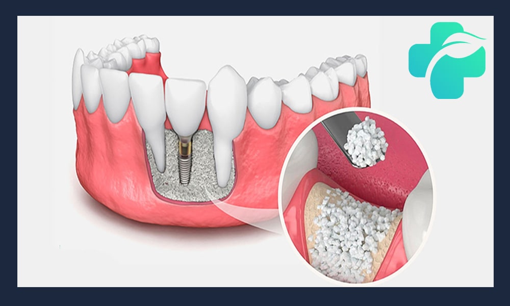تاثیر پوکی استخوان بر ایمپلنت