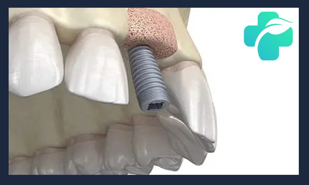 تاثیر پوکی استخوان بر ایمپلنت