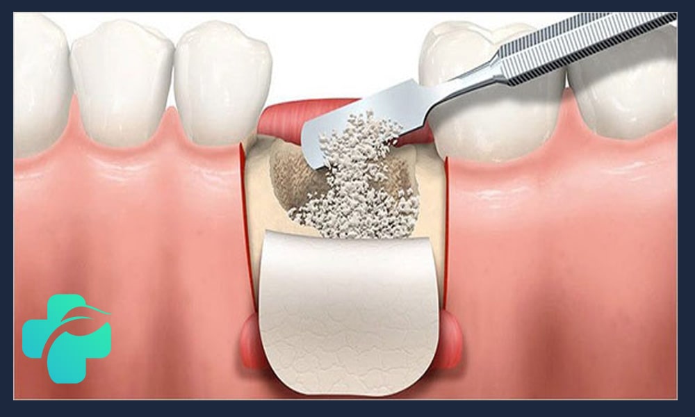 تاثیر پوکی استخوان بر ایمپلنت