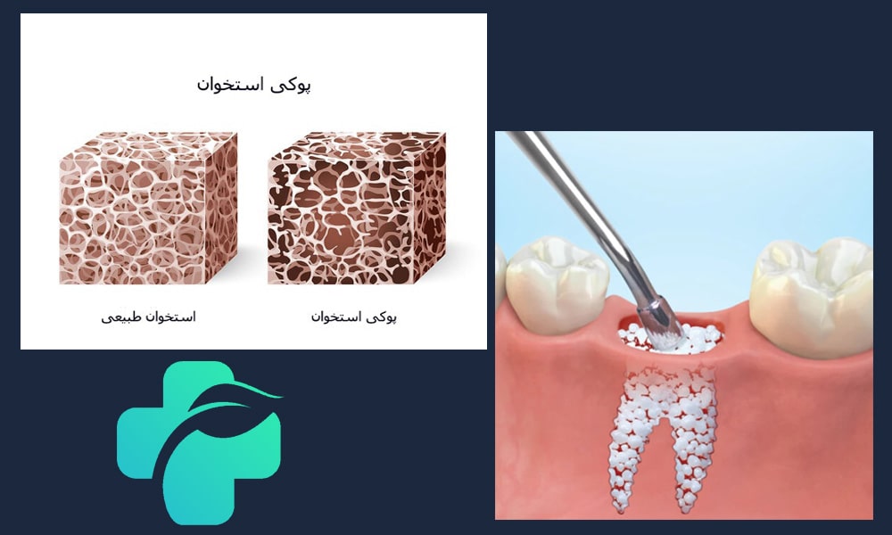 تأثیر پوکی استخوان بر ایمپلنت