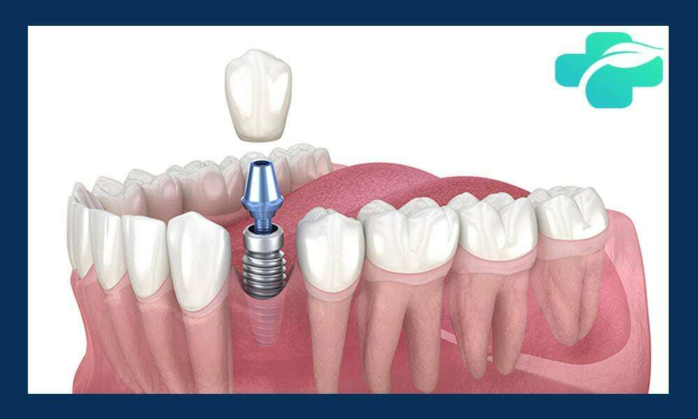 ایمپلنت دندان