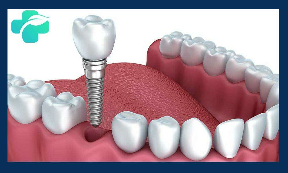 ایمپلنت دندان