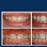 جراحی افزایش طول عاج دندان