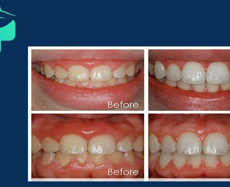 جراحی افزایش طول عاج دندان