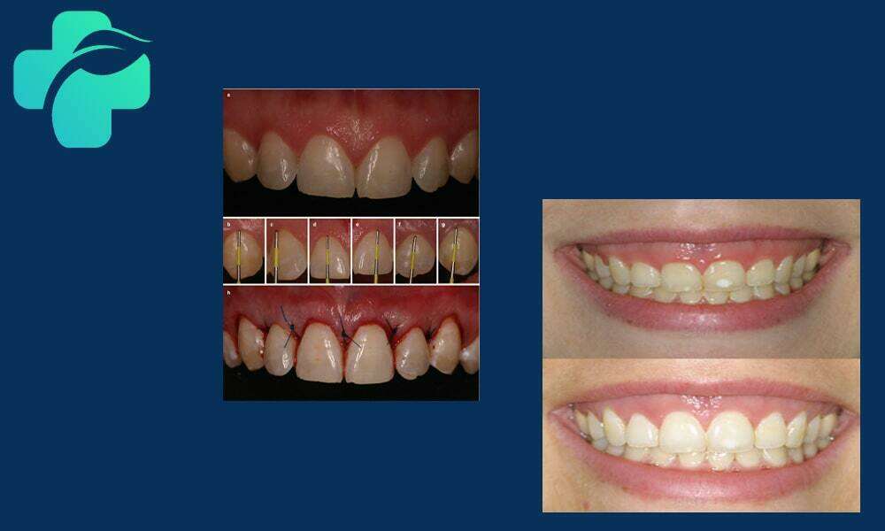 جراحی افزایش طول تاج دندان