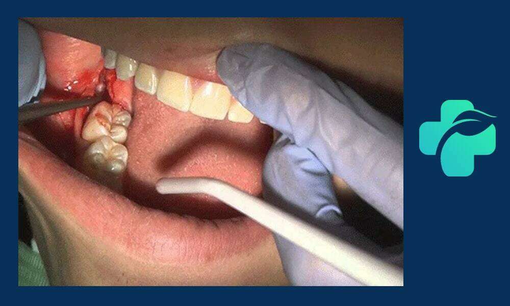 جراحی دندان عقل