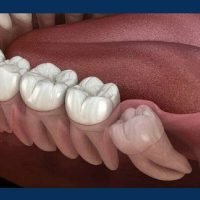 جراحی دندان عقل