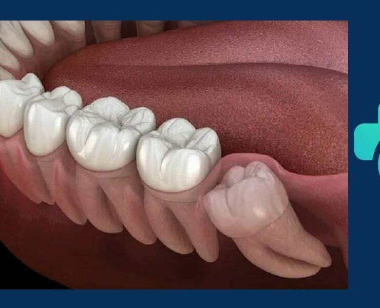 جراحی دندان عقل