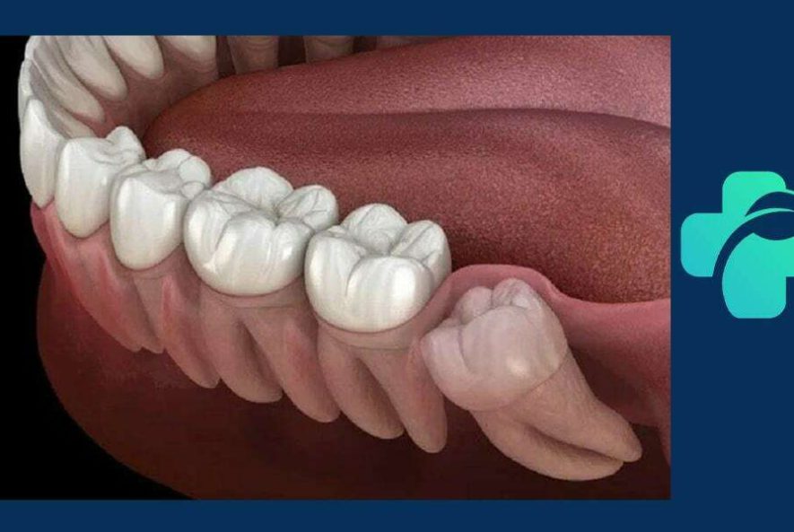 جراحی دندان عقل