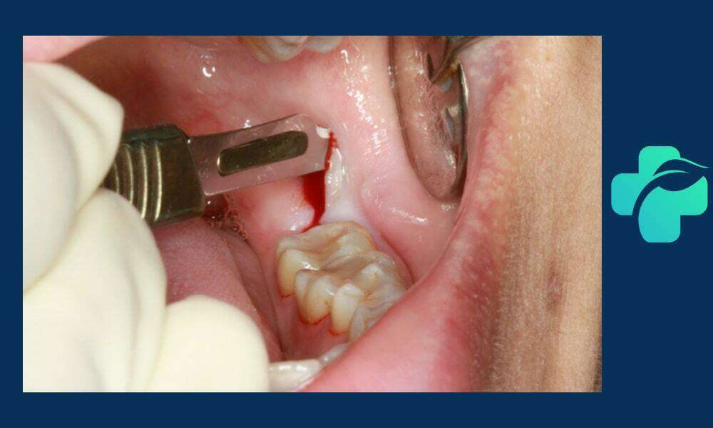 جراحی دندان عقل