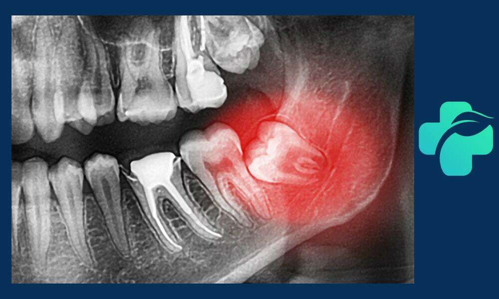 جراحی دندان عقل