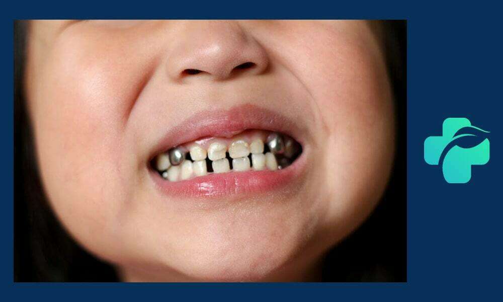 روکش دندان اطفال