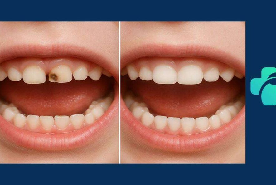 روکش دندان اطفال