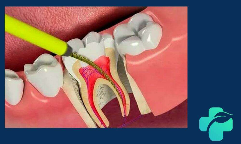 عصب کشی دندان