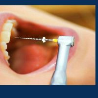 عصب کشی دندان