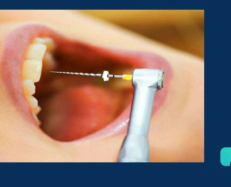 عصب کشی دندان