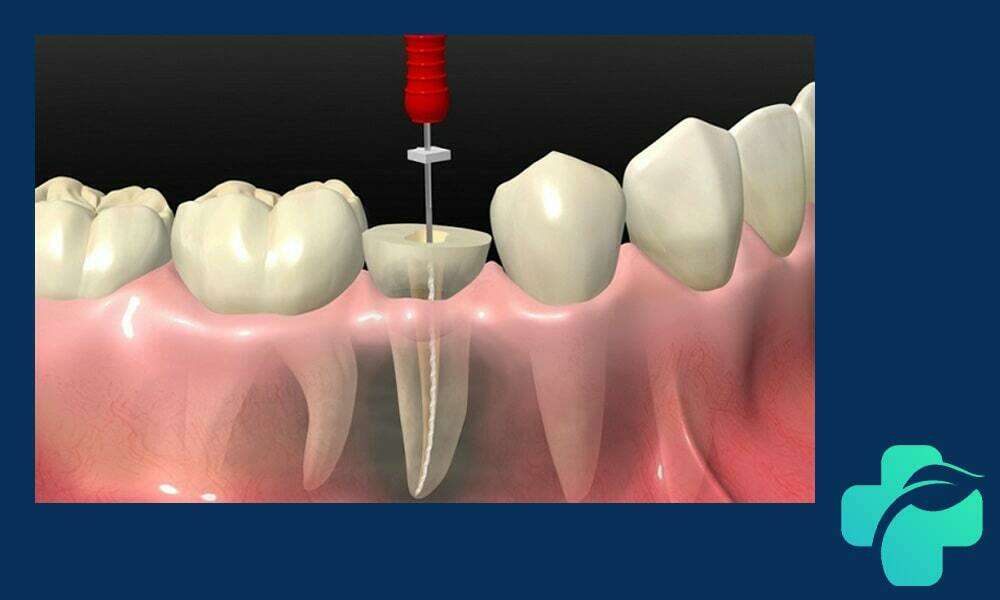 عصب کشی دندان