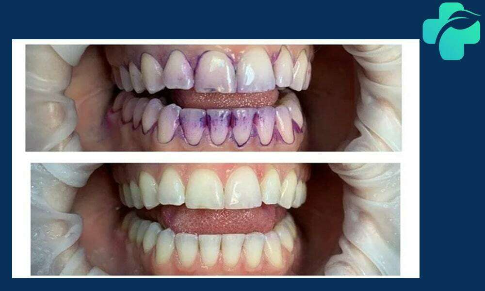 فلوراید تراپی