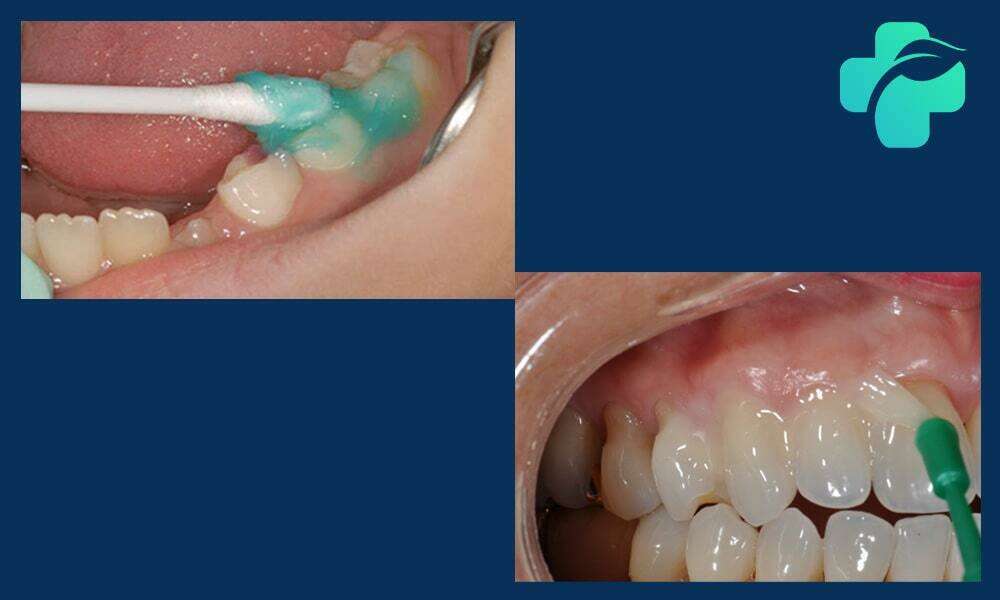 فلوراید تراپی