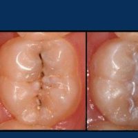 خدمات فیشور سیلانت