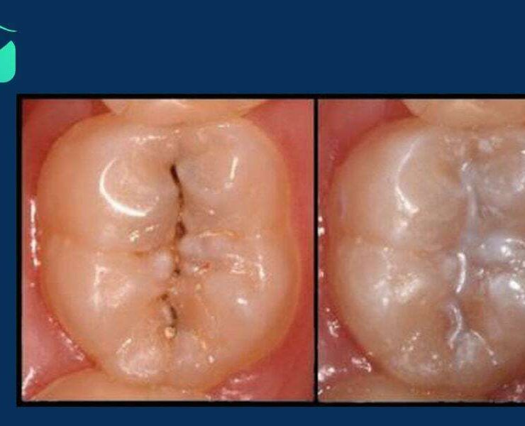 خدمات فیشور سیلانت