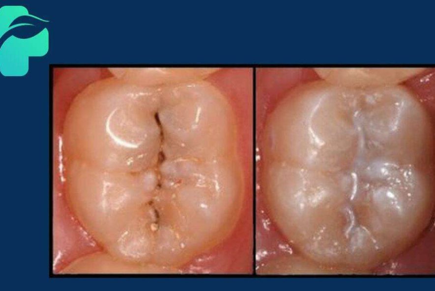 خدمات فیشور سیلانت
