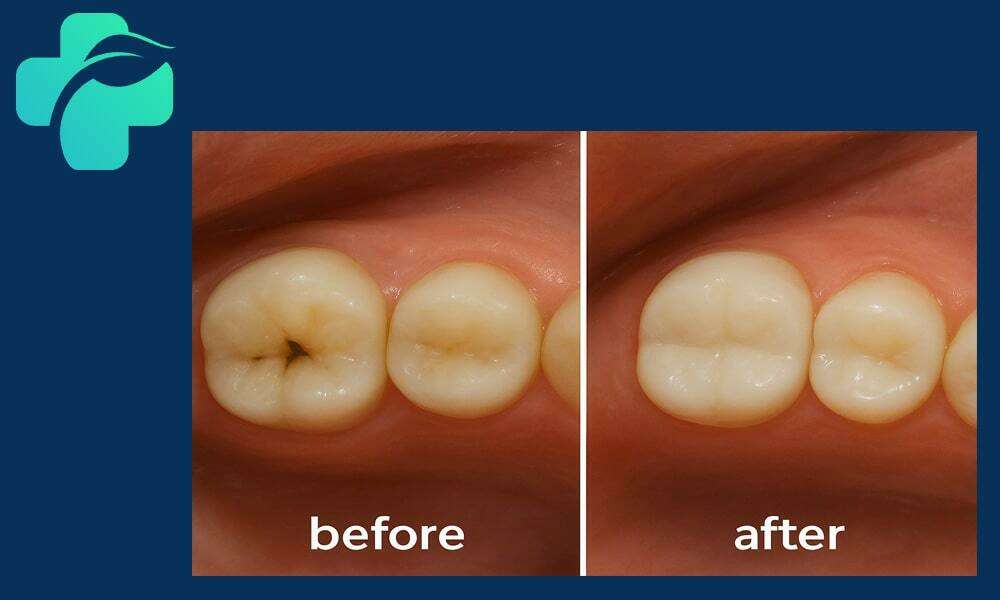 خدمات فیشور سیلانت