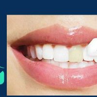 لمینت دندان