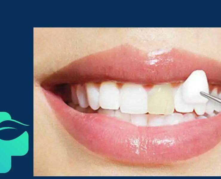 لمینت دندان