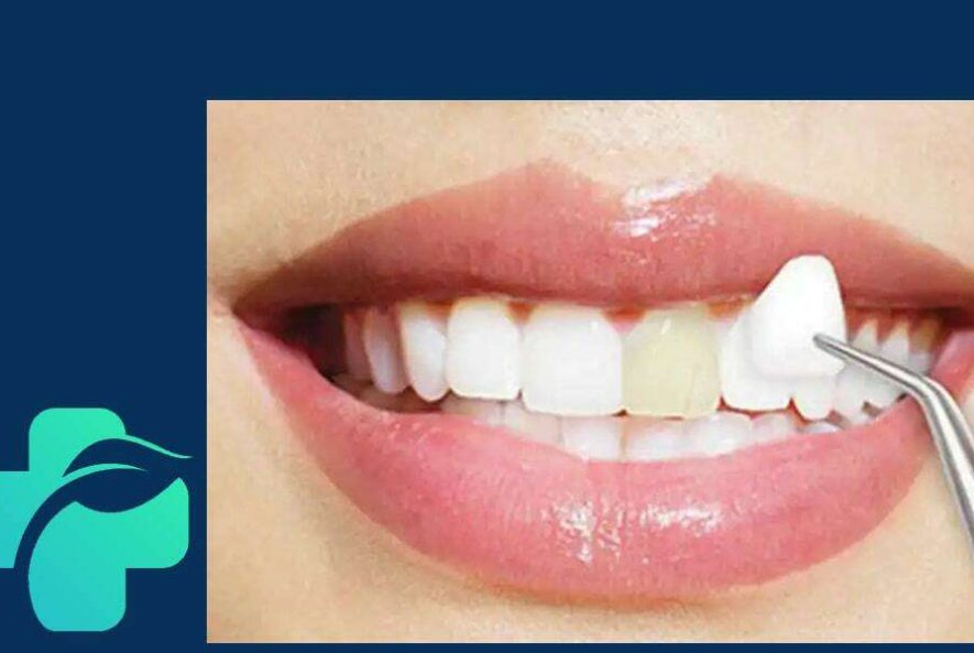 لمینت دندان