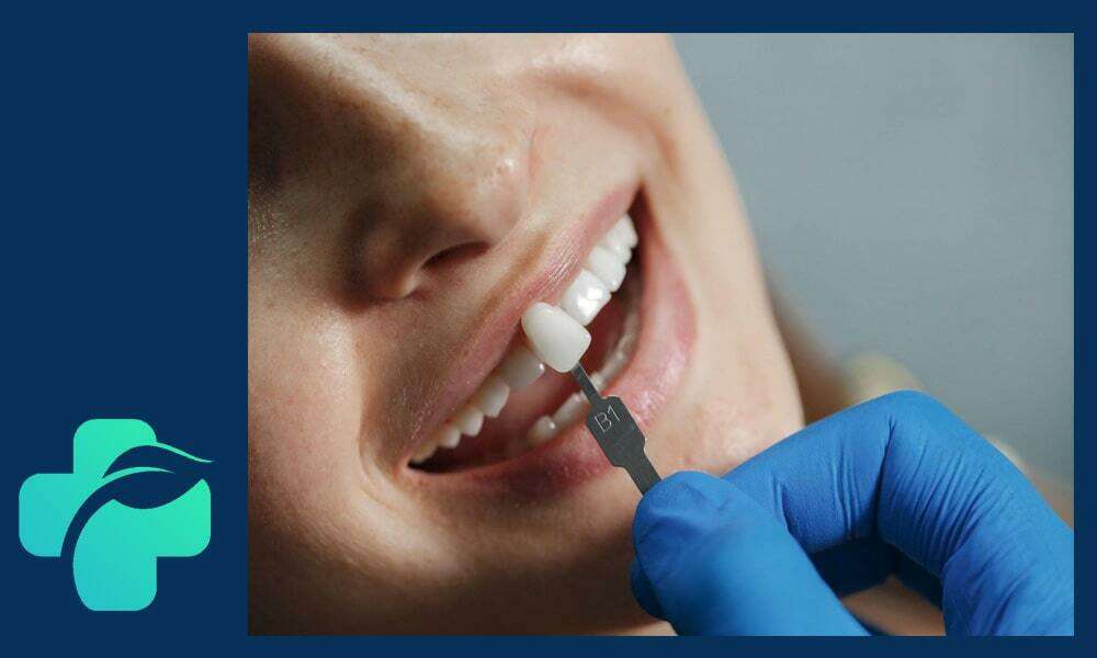 لمینت دندان