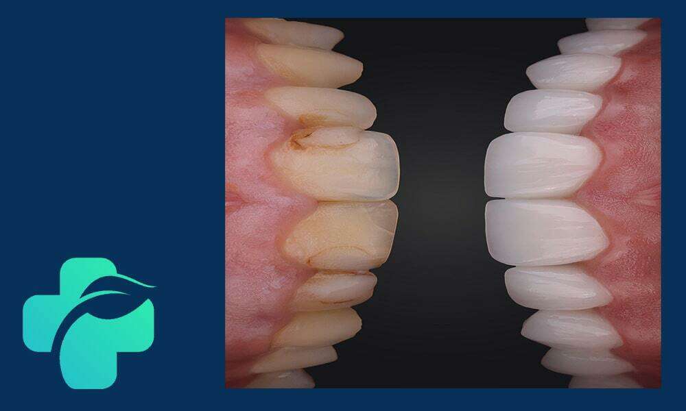 لمینت دندان